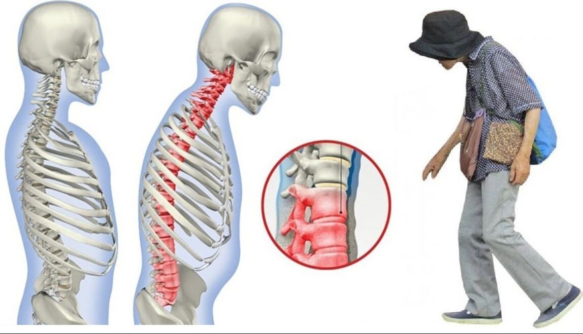 bolesť chrbta v dôsledku ankylozujúcej spondylitídy