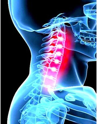 Klinický obraz osteochondrózy